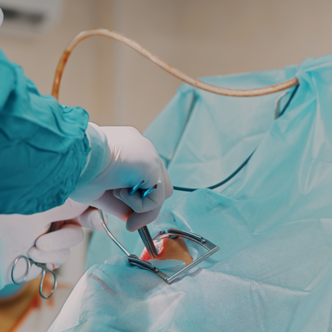 Close up shot of an oral surgery procedure