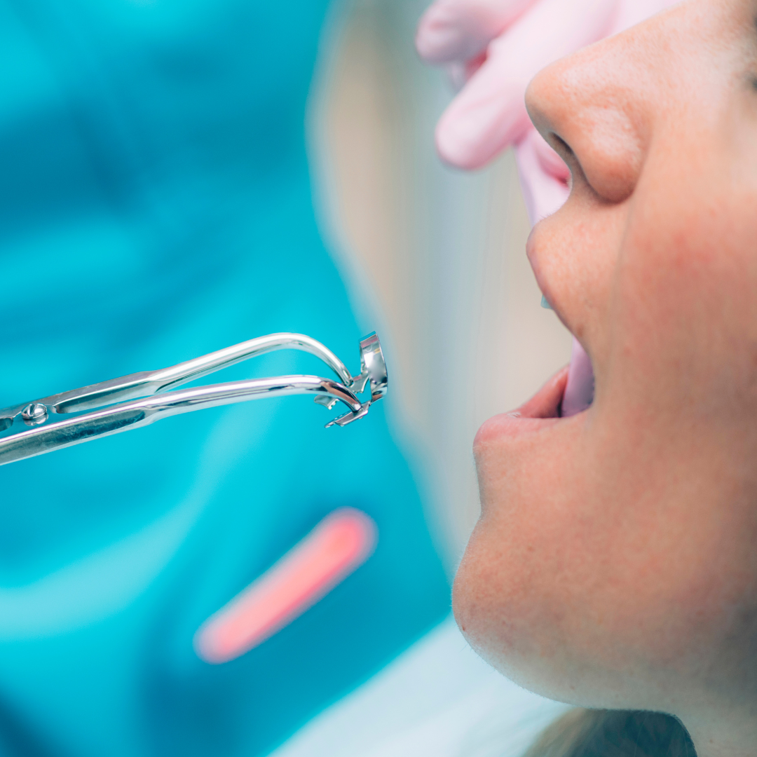 Close up shot of a woman receiving endodontic care